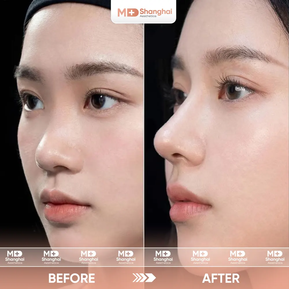 Kết quả nâng mũi trước và sau tại MD Shanghai Aesthetics – ca 1