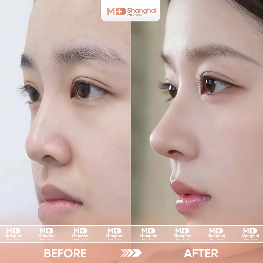 Kết quả nâng mũi trước và sau tại MD Shanghai Aesthetics – ca 2