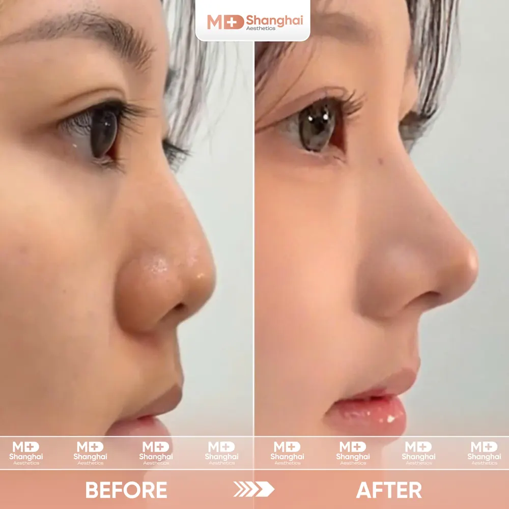 Kết quả nâng mũi trước và sau tại MD Shanghai Aesthetics – ca 3