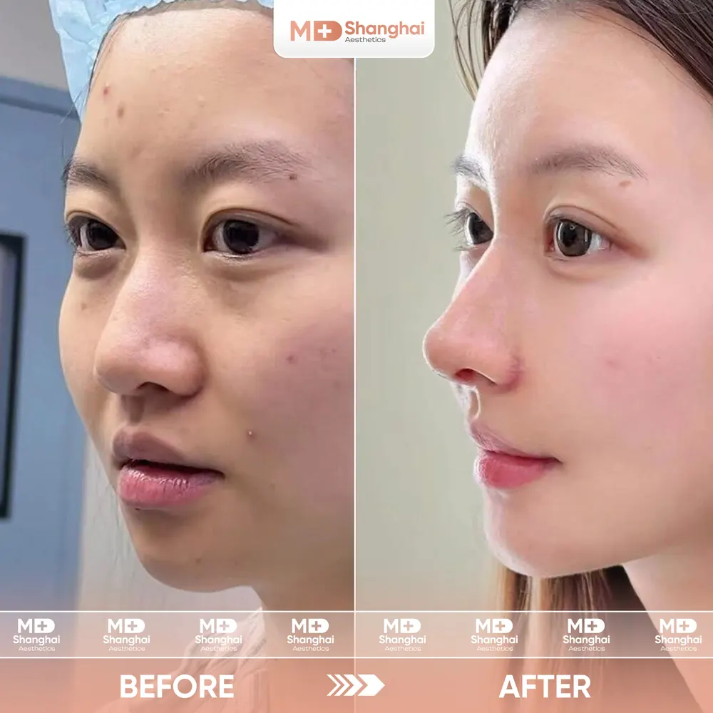 Kết quả nâng mũi trước và sau tại MD Shanghai Aesthetics – ca 4