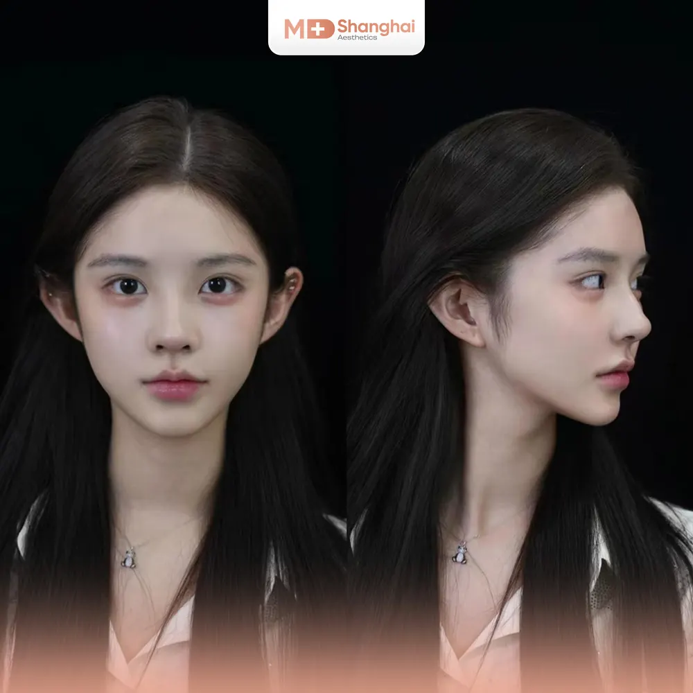 Dáng mũi sau nâng hài hòa gương mặt – MD Shanghai Aesthetics