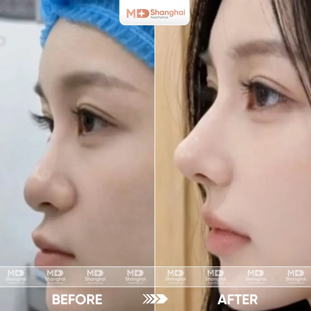 Kết quả nâng mũi trước và sau tại MD Shanghai Aesthetics – ca 5