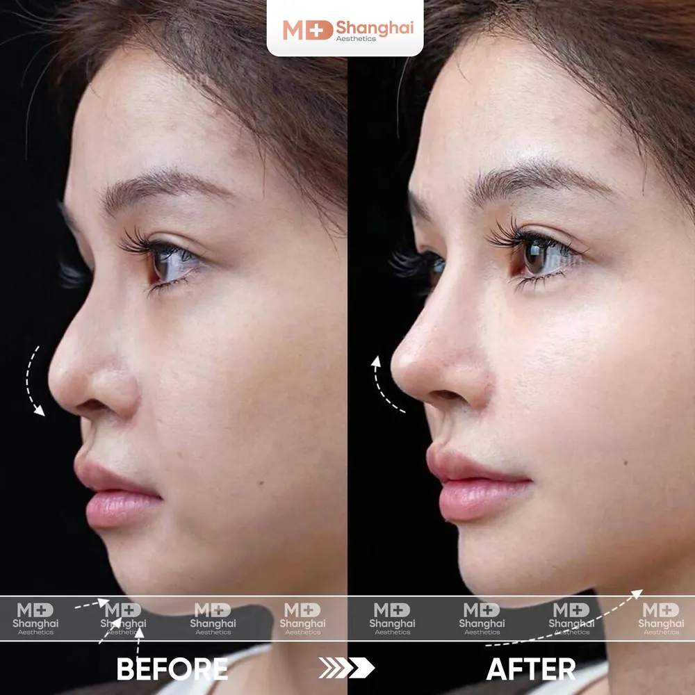 Kết quả nâng mũi trước và sau tại MD Shanghai Aesthetics – ca 6