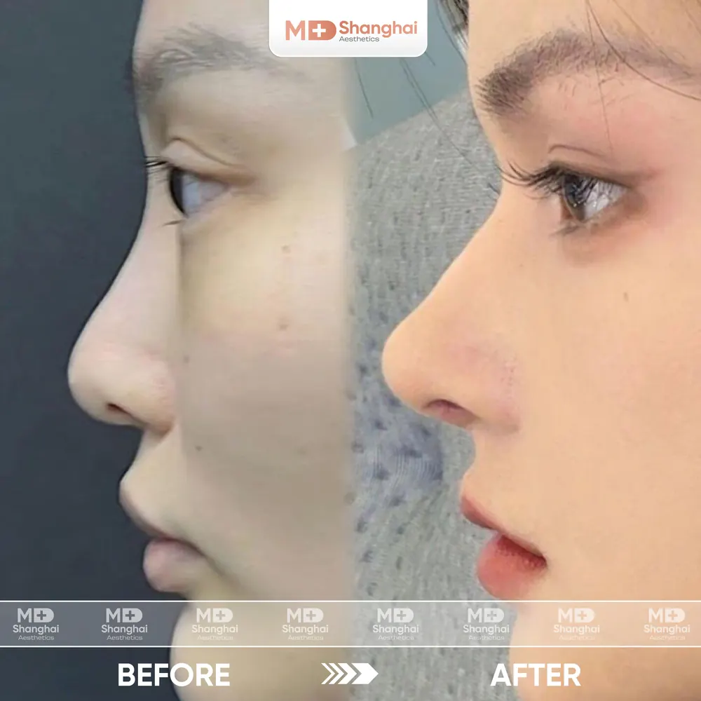 Kết quả nâng mũi trước và sau tại MD Shanghai Aesthetics – ca 7