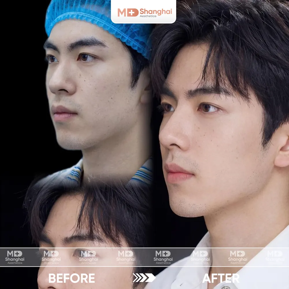 Kết quả nâng mũi nam giới trước và sau tại MD Shanghai Aesthetics – ca 8