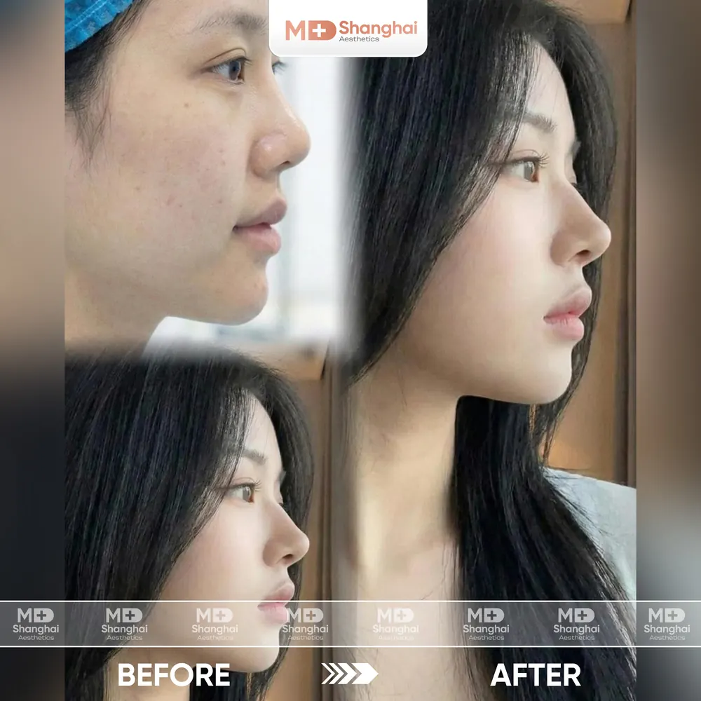Kết quả nâng mũi trước và sau tại MD Shanghai Aesthetics – ca 9