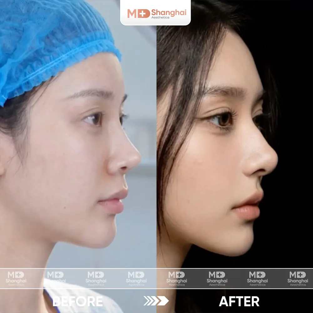 Kết quả nâng mũi trước và sau tại MD Shanghai Aesthetics – ca 10